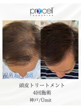 ユミト(Umit)/プロセルスカルプ