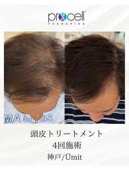 ユミト(Umit)/プロセルスカルプ