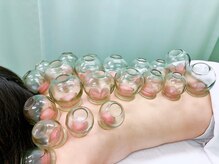 たくみ整体院/吸い玉