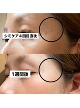 モイラ(MOIRA)/こめかみ気になりませんか？