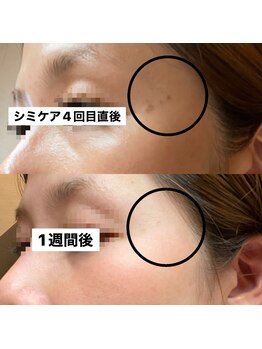 モイラ(MOIRA)/こめかみ気になりませんか？