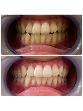 ホワイトベリー 空港通店(White Berry)/ホワイトニング：ビフォアフター