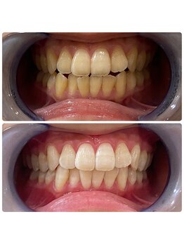 ホワイトベリー 空港通店(White Berry)/ホワイトニング:ビフォアフター