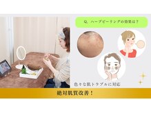 鍼灸院 はりエイト/◇ハーブピーリングの効果は？