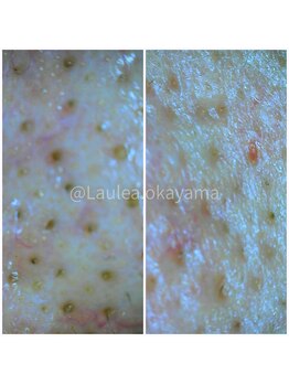 ラウレア(Laule'a)/毛穴ケア