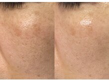 モガナ(mogana)/赤ちゃん肌ピーリング