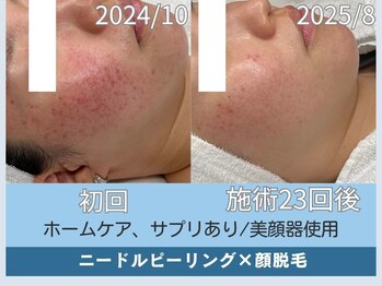 アロマ(AROMA)/凹凸跡/毛穴/越谷せんげん台