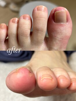 リゼラアンドコー 柏原店/正しい爪切りで快適な歩行へ