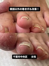 巻き爪じゅん 千葉駅前店/根本から整える最新矯正