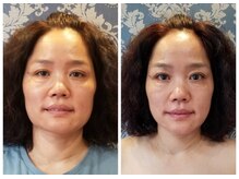 アゴラ/【小顔】【中国での実績もあり】