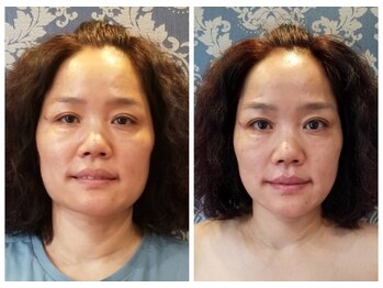 アゴラ/【小顔】【中国での実績もあり】