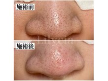 結果重視の最新毛穴ケア！毛穴の詰まりがなくなるとお肌が激変！