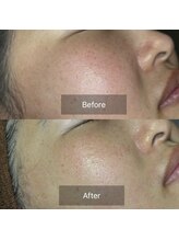 セメ(S’aimer)/ハーブピーリング4回コース☆