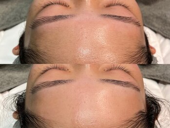 オパール 大阪梅田(op_l)/毛穴ケア/毛穴洗浄/毛穴黒ずみ