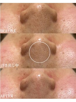 エース(ACE.)/毛穴詰まり改善☆