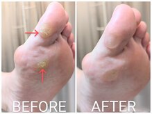 リヴィエール(Riviere)/50代女性　タコ、魚の目の痛み