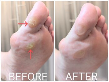 リヴィエール(Riviere)/50代女性　タコ、魚の目の痛み