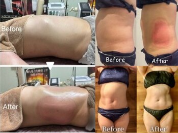 ボディーリセット 勝どき/≪脂肪冷却 before/after≫