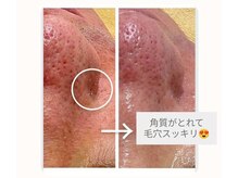 クレール 小山店(CLAIR)/【角質除去】毛穴洗浄