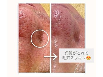 クレール 小山店(CLAIR)/【角質除去】毛穴洗浄