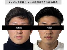 アロエベル(aloe Belle)/Before After（4回施術）