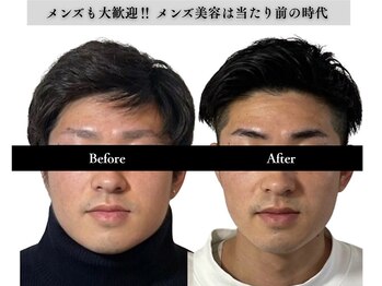 アロエベル(aloe Belle)/Before After（4回施術）