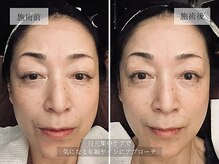 ル キヤ アイスペシャリテ ハービスENT店/ビフォーアフター◆目元再生ケア