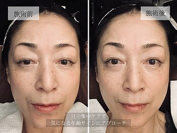 ル キヤ アイスペシャリテ ハービスENT店/ビフォーアフター◆目元再生ケア