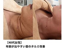 ボニータ(Bonita)/【Lit】ヒト臍帯幹細胞エステ