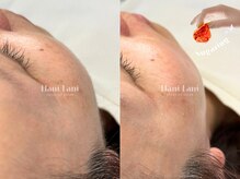 ハニ ラニ(Hani Lani)/お肌のくすみ？それうぶ毛かも？