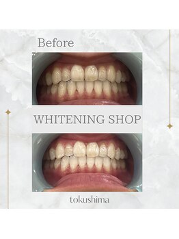ホワイトニングショップ 徳島店/セルホワイトニング1回の効果
