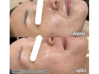 チアフル 鶴見店(Cheerful)の写真/毛穴の黒ずみ・開き・角栓もごっそり除去◎上質なピーリングで本気の肌質根本改善！透明感溢れる水光肌に♪