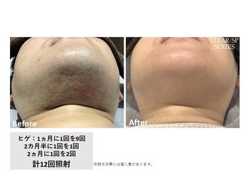 ロカビリー(Rockabilly)/メンズ　ヒゲ脱毛