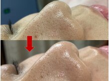 ブリリアン デイスパ 阪急西宮ガーデンズ店(BRILLIAN DAYSPA)/毛穴洗浄フェイシャル