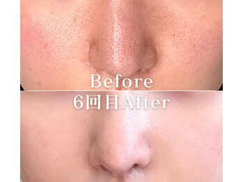 ミニョスキンラボ/韓国式ハーブピーリング6回