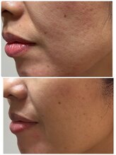 シャイン(shine)/VOSサロンケア