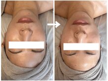 ラディアンス/小顔たるみ特化フェイシャル