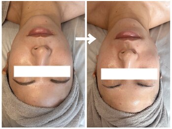 ラディアンス/小顔たるみ特化フェイシャル