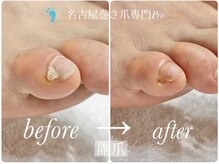 名古屋巻き爪専門Proの雰囲気(靴に引っかかる痛い小指の副爪を綺麗に取り除きます。)