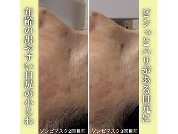 ハニエル(Haniel)/ゾンビマスク症例