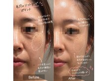 トータルビューティ リライフ(Total beauty Relife)の雰囲気（美肌ピールとリフトアップマシン3回で土台を作ります。）