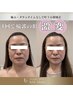 【エラ・頬・歪み・面長・輪郭お悩み】美人黄金比コース90分¥12000→¥8400