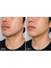 メンズビューティーSMOOOTH ～脱毛・メンズフェイシャル・眉毛WAX・ホワイトニング～/ヒゲ脱毛のお客様のビフォーアフ
