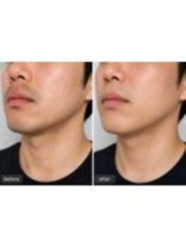 メンズビューティーSMOOOTH ～脱毛・メンズフェイシャル・眉毛WAX・ホワイトニング～/ヒゲ脱毛のお客様のビフォーアフ