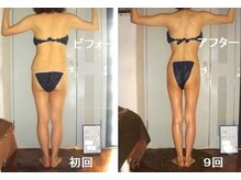 痩身 セル脂肪専門 スタイルデザイン/ビフォーアフター施術9回★背中