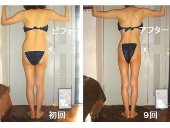 痩身 セル脂肪専門 スタイルデザイン/ビフォーアフター施術9回★背中