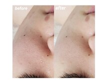 プシュケ(Psyche)/お客様の肌変化【頬の毛穴】