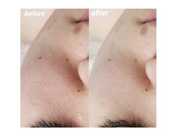 プシュケ(Psyche)/お客様の肌変化【頬の毛穴】