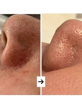 ハズキ(HAZUKI)/手ごわい毛穴も1回で改善