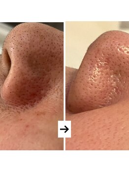 ハズキ(HAZUKI)/手ごわい毛穴も1回で改善